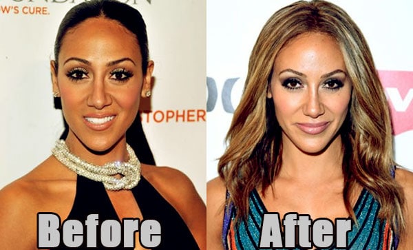 Image of Melissa Gorga plastic surgery before and after